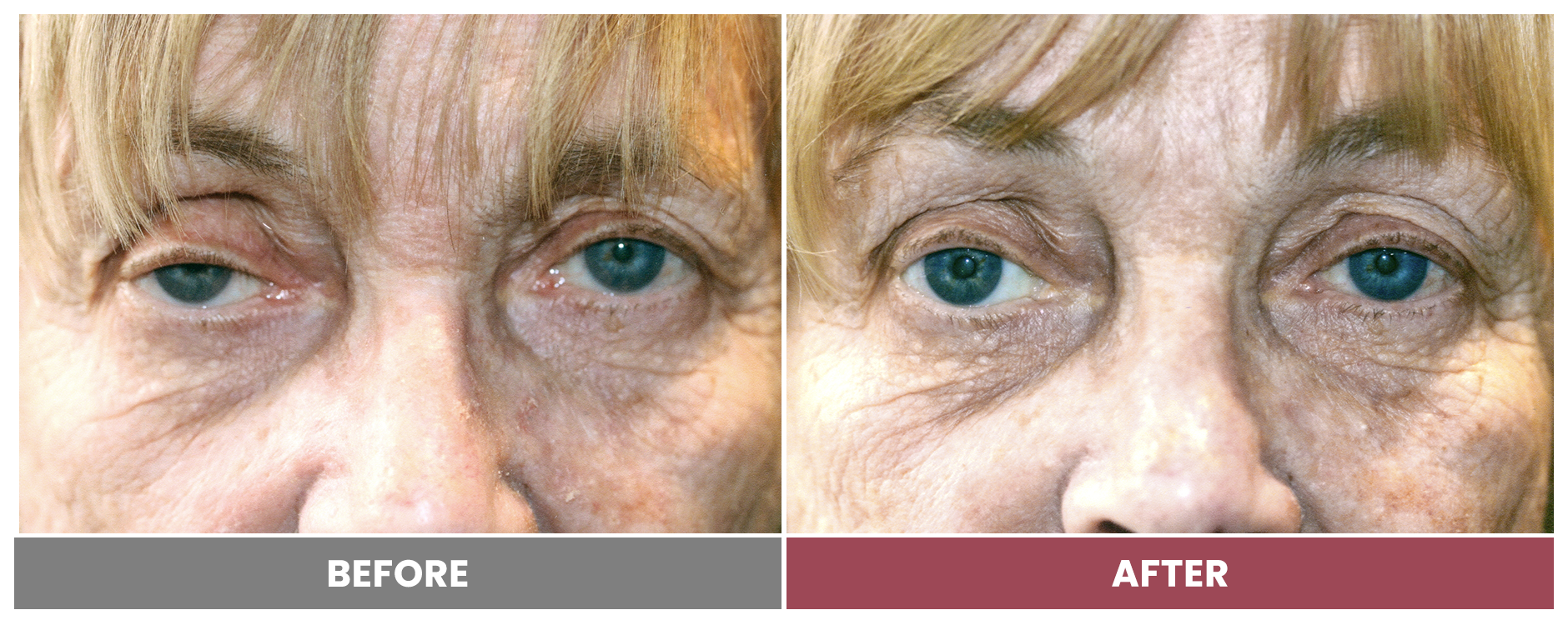 PTOSIS REPAIR - Case 30